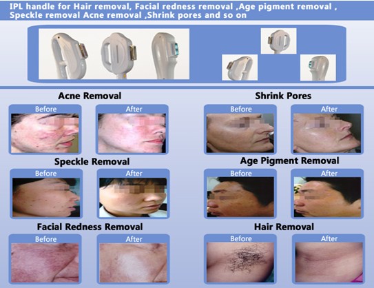 E-luz IPL RF de Verticle, máquina da beleza da remoção do cabelo de Yag/remoção da tatuagem