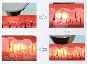 Equipamento da beleza do laser do diodo da remoção 808nm do cabelo
