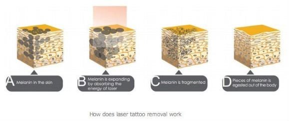 Sistema profissional da remoção da tatuagem do laser do yag do nd do interruptor da clínica q com promoção grande