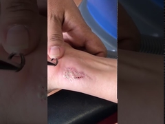 Dispositivo eficaz da remoção da tatuagem do laser do Nd Yag Q do interruptor poderoso de Y6