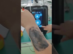 Dispositivo de remoção de tatuagens a laser de picosegundos