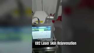 30W RF Tube Fractional CO2 laser para remoção de cicatrizes e aperto da pele