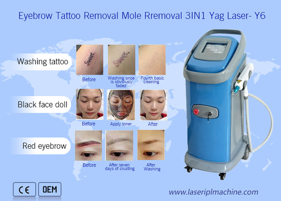 1064nm/532nm dermatologia da máquina da remoção da tatuagem do laser do Nd Yag