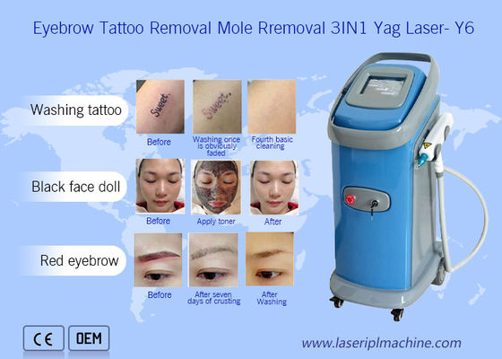 Bom preço 1064nm 532nm Nd Yag Máquina de remoção de tatuagens a laser Dermatologia on-line